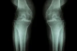 Kniegelenk Arthrose