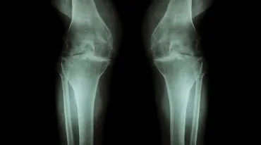 Kniegelenk Arthrose