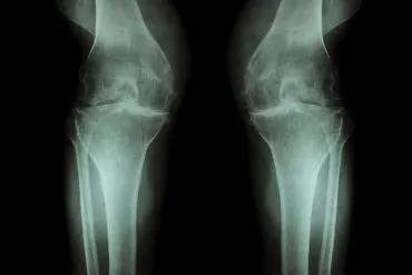 Kniegelenk Arthrose